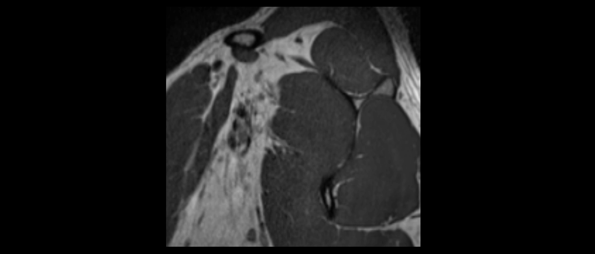 shoulder ligaments sagittal  cross sectional anatomy 3T MRI AI enhanced radiology image -img-00001-00002.webp